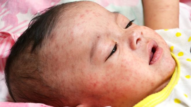 child with measles